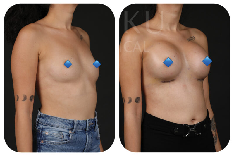 400 cc Implants: Achieving Your Ideal Breast Size Before and after picture of a patient who has undergone 400 cc implant breast augmentation at Doku Clinic with Dr . Engin Öcal
