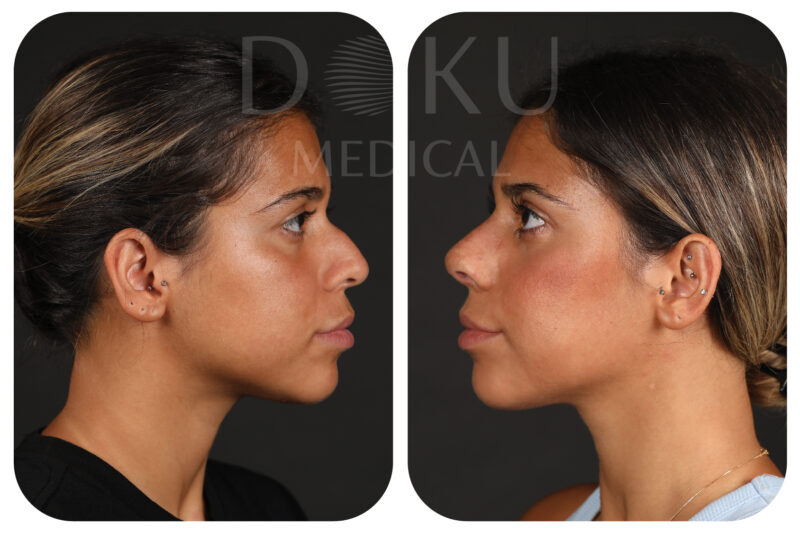 Ethnic rhinoplasty before and after result at Doku Clinic in Istanbul, Turkey