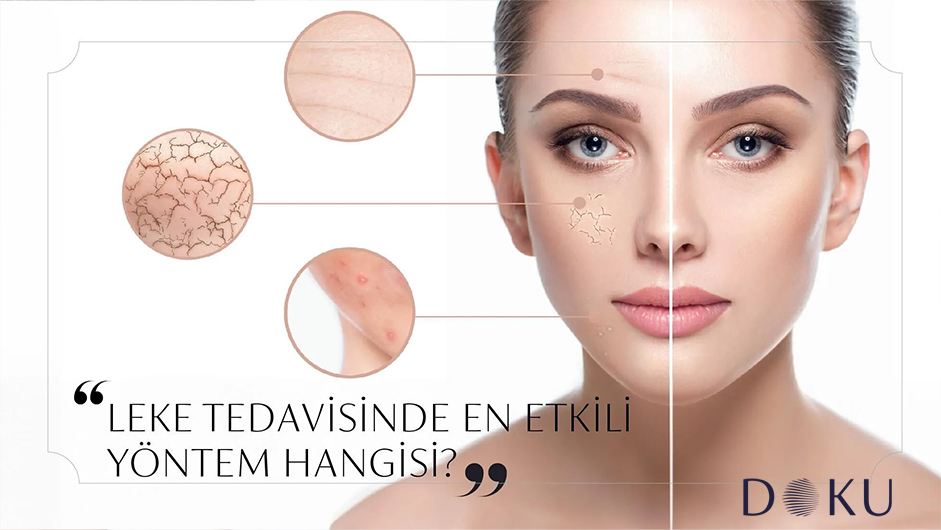 Leke Tedavisinde En Etkili Yöntem Hangisi?
