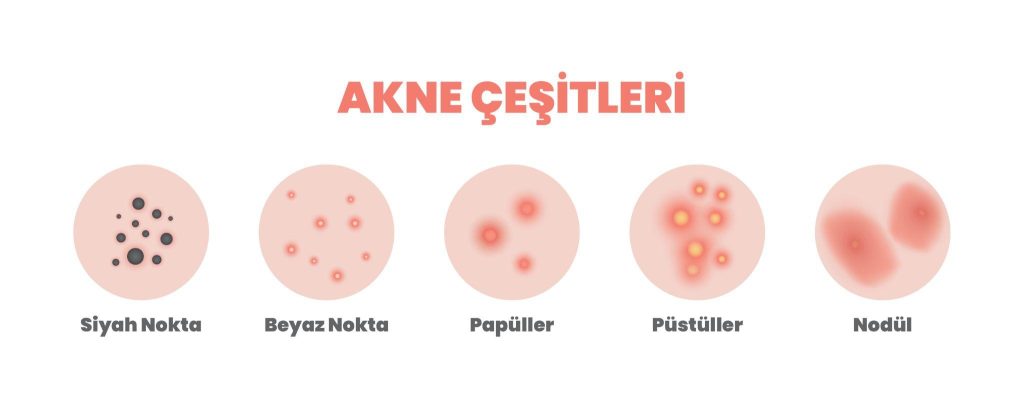 sivilce1