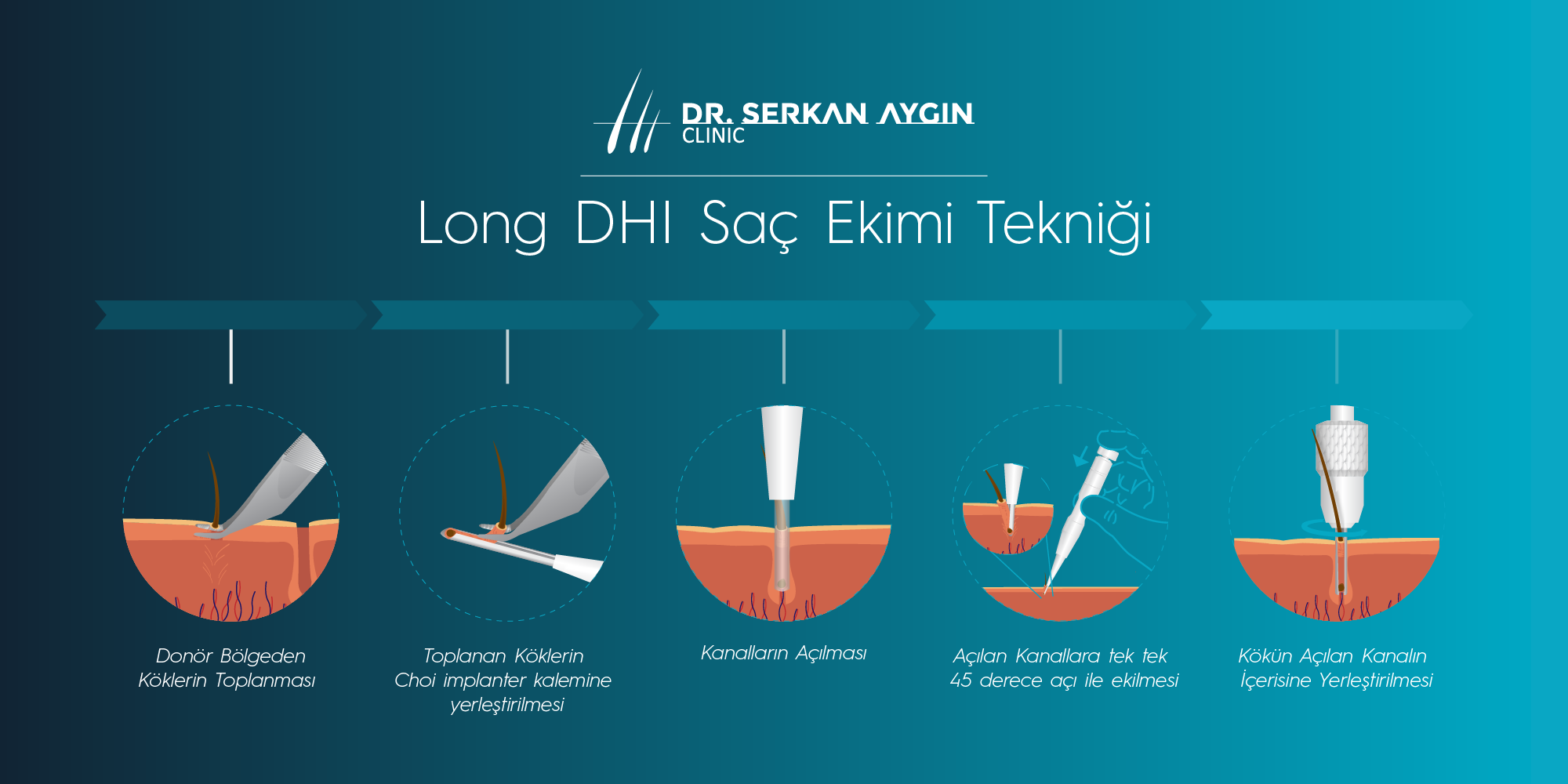Long DHI Saç Ekimi Tekniği Şeması