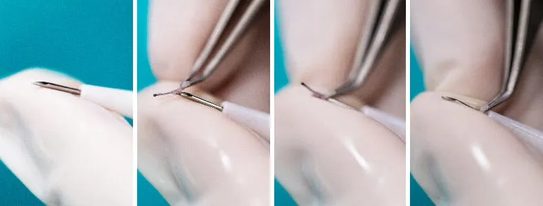 Greffe de cheveux Greffe de cheveux