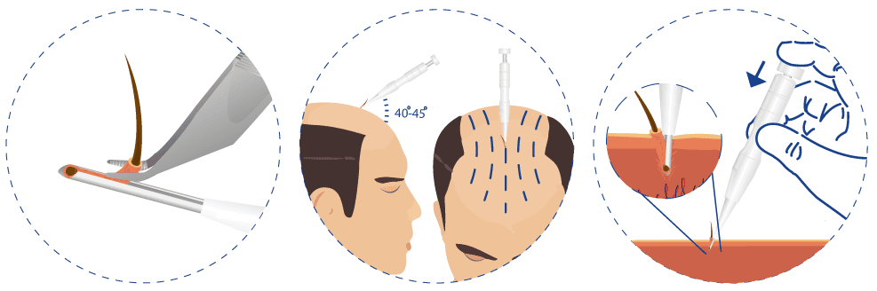 Greffe de cheveux Greffe de cheveux