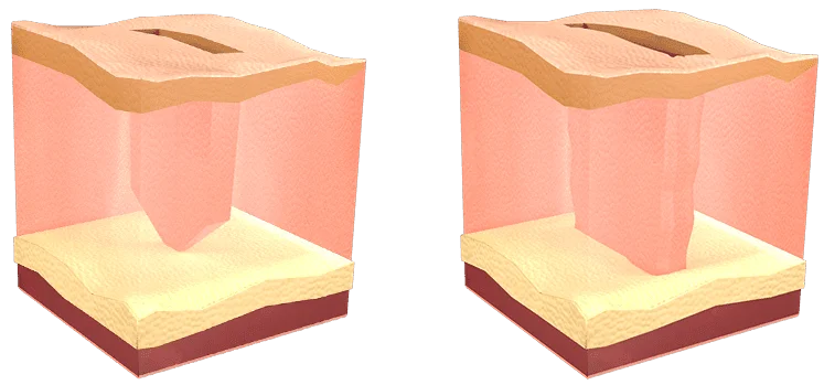 Greffe de cheveux Greffe de cheveux