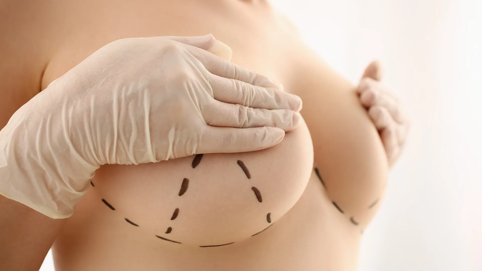 Breast Lift Turkey: The 2026 Clinical Guide to Mastopexy in Istanbul by Doku Clinic Experts