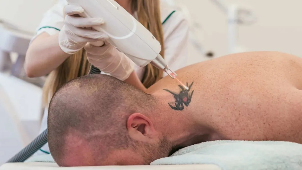 Dövme Sildirmek İçin: Starwalker Lazer Nedir?