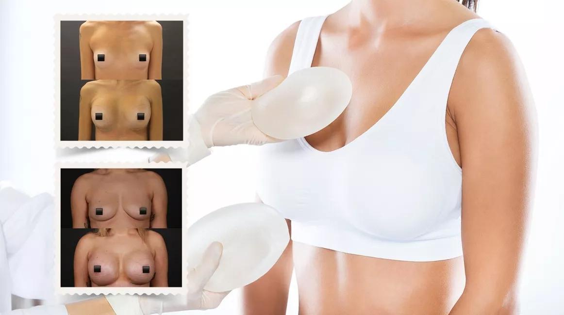 Mommy Makeover Turkey: Breast Surgery After Pregnancy Mommy Makeover Turkey: Breast Surgery After Pregnancy