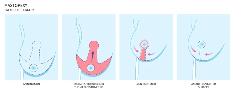 Lifting del seno lollipop: mastopessi verticale per un ringiovanimento naturale Infographic showing how breast lift surgery works, step by step in 4 key phases