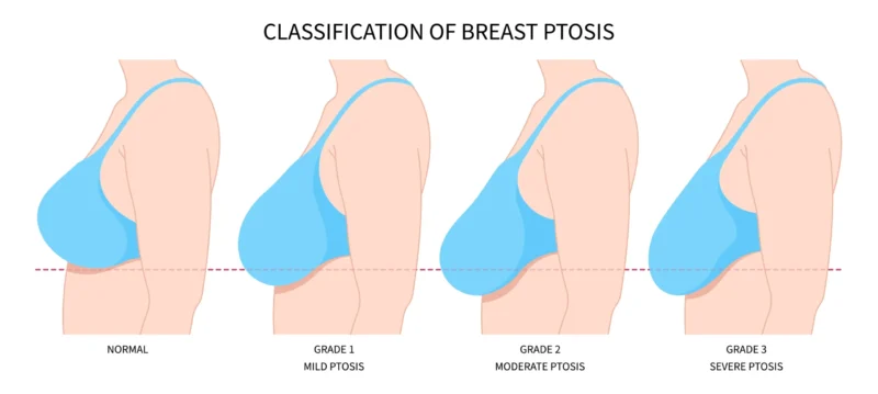 Mastopessi Senza Protesi: Guida Medica al Lifting Naturale del Seno Infographic image showing the evolving stages of breast ptosis.