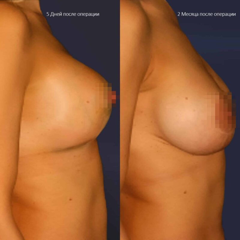 Mastopessi Senza Protesi: Guida Medica al Lifting Naturale del Seno Breast Lift Without Implants before and after