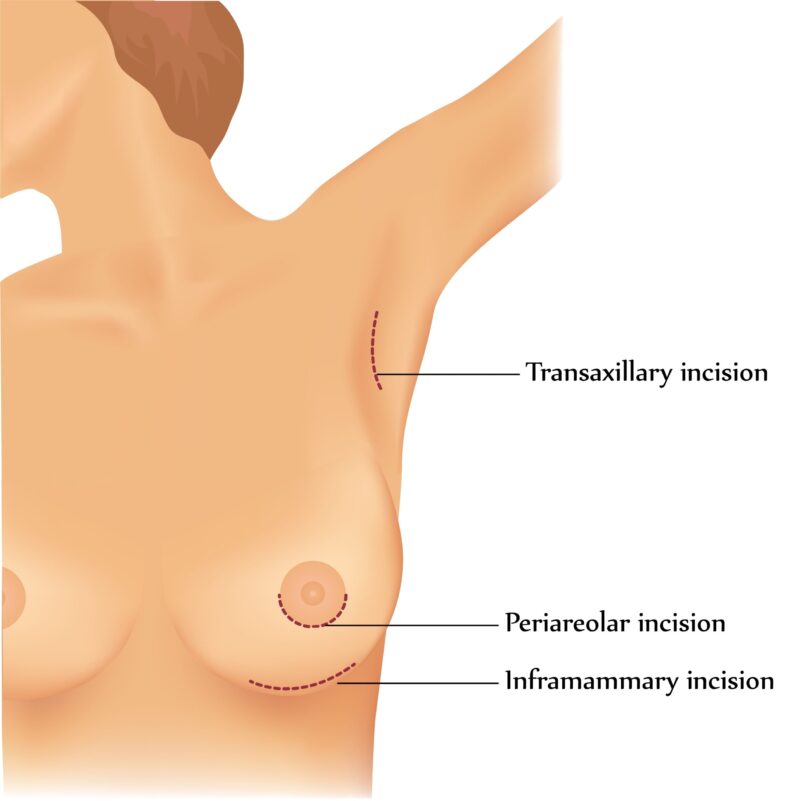 Augmentation mammaire transaxillaire : des prothèses posées par l'aisselle, sans cicatrice sur le sein Augmentation mammaire transaxillaire : des prothèses posées par l'aisselle, sans cicatrice sur le sein