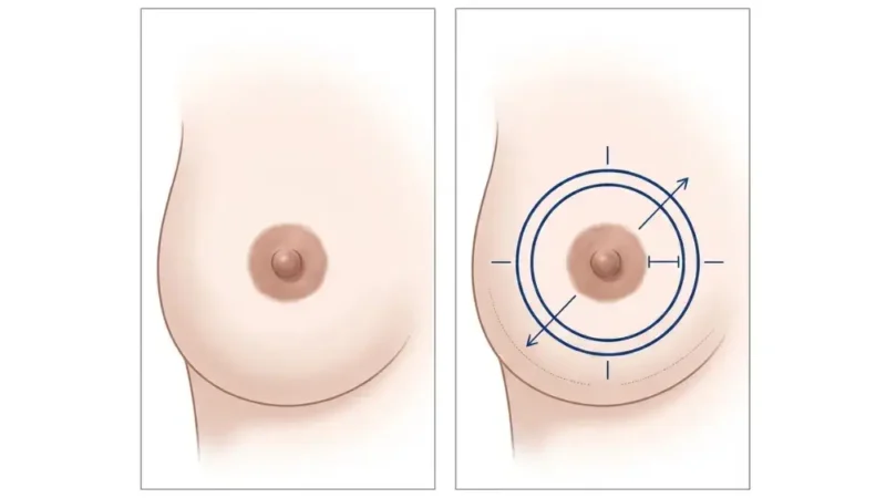 Donut-Brustlift (Periareolär): Ergebnisse & Kosten | Dr. Öcal Medical illustration showing how the donut breast lift incision is performed