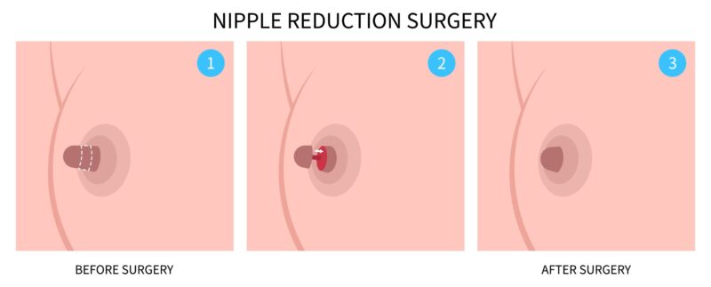 Réduction des mamelons : coût, intervention et convalescence Medical illustration showing the 3-stages of nipple reduction surgery