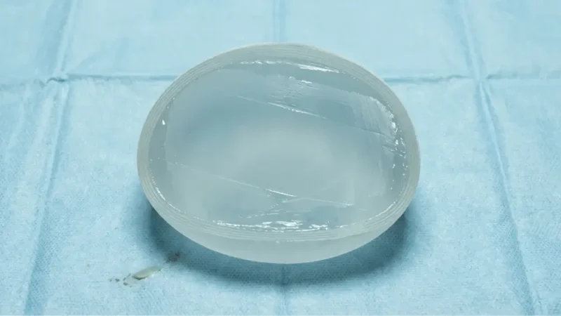 Arten von Brustimplantaten: die passende Größe, Form und Füllung finden A close-up view showing breast implant anatomy, featuring a clear, round silicone gel implant resting on a light blue medical drape.