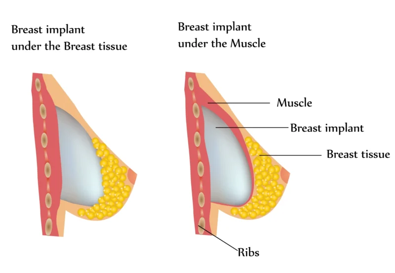 Implants en silicone rétromusculaires : guide complet, prix et comparatif des positionnements Medical illustration comparing sub muscular vs sub glandular breast implant placement